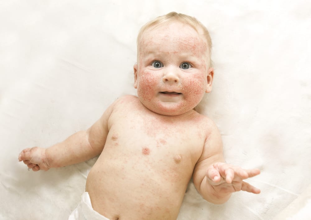 幼児の湿疹