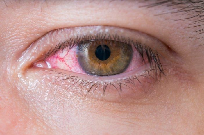 アレルギー性赤目結膜炎