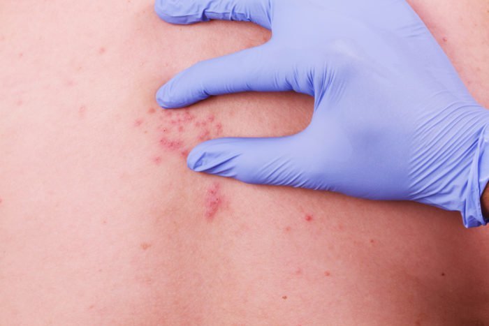 帯状疱疹とは何ですか？水痘または天然痘の蛇の痛み