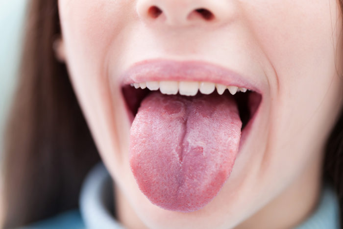 舌乾癬