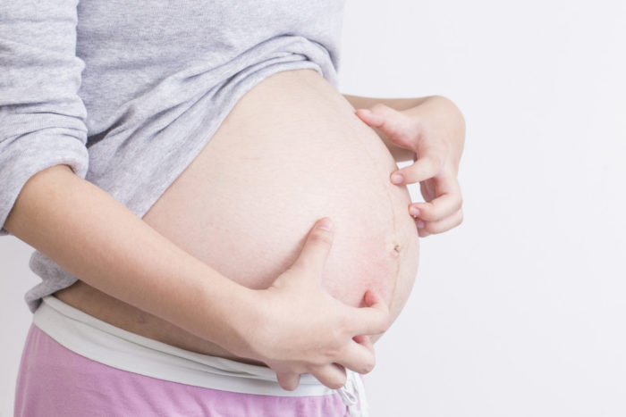 そう痒性毛包炎は、妊娠中のかゆみを伴う皮膚の原因です。